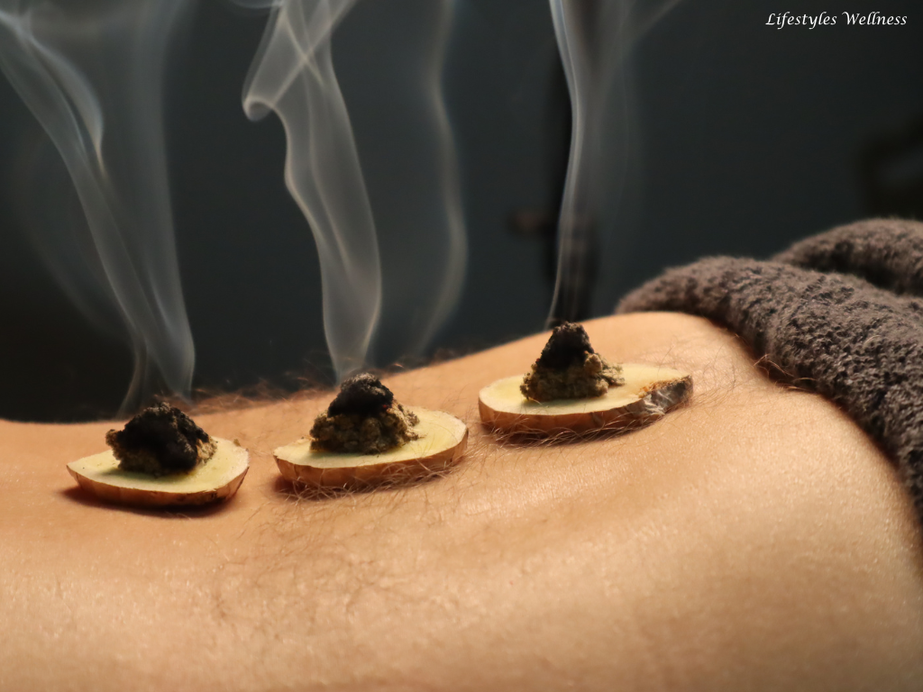 Moxibustion